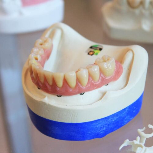 Invisalign Services in Randolph, NJ 2 Dentures on mold